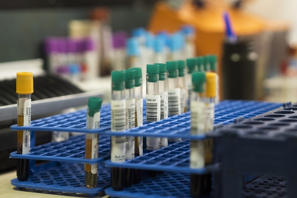 A laboratory scene featuring multiple blood tubes arranged on a countertop, indicating ongoing medical analysis.